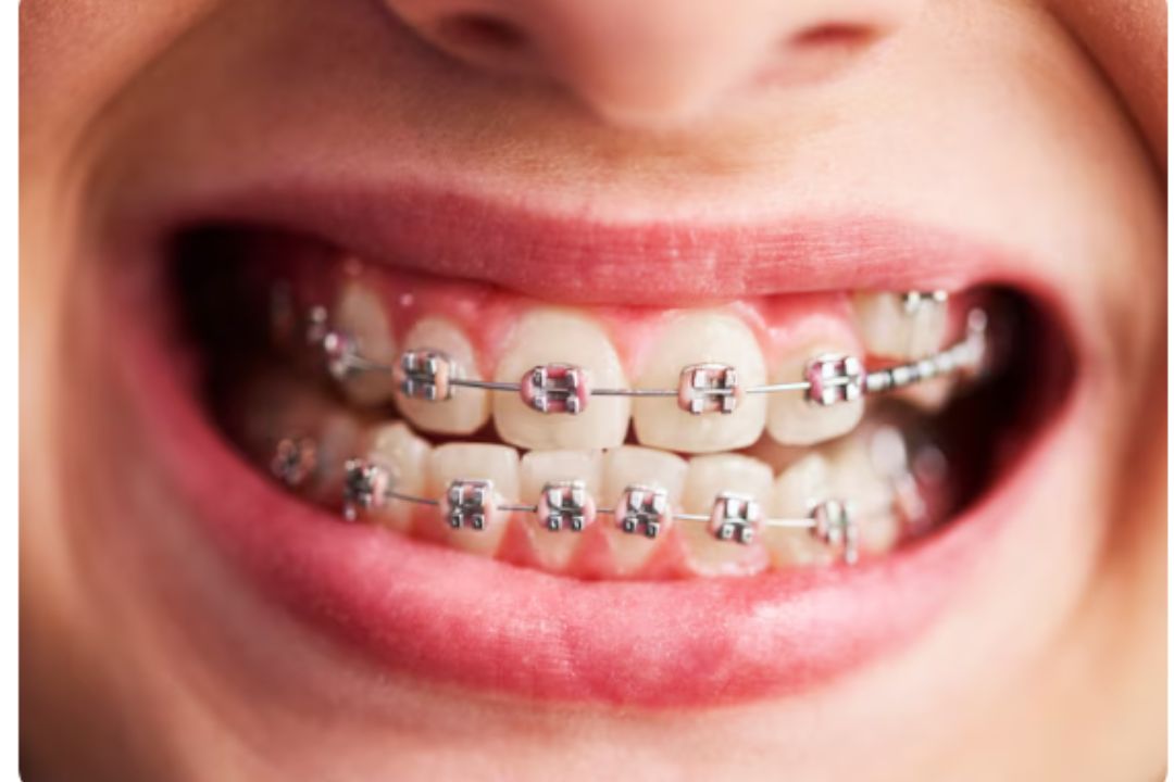 affordable braces and clear aligners cost guide in mumbai